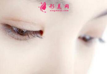 雙眼皮整形常見的后遺癥風(fēng)險(xiǎn)