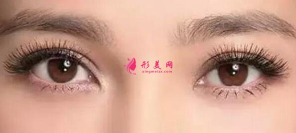 雙眼皮整形常見的后遺癥風(fēng)險(xiǎn)