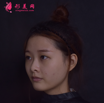 找成都成美整形醫(yī)院王立鵬做的自體軟骨隆鼻,價格_案例分享