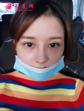 找成都成美整形醫(yī)院王立鵬做的自體軟骨隆鼻,價格_案例分享