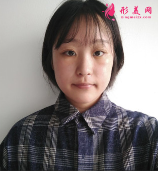 成都美萊做雙眼皮多少錢(qián)_埋線(xiàn)雙眼皮+外開(kāi)眼角怎么樣_案例效果