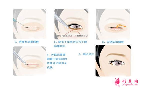做去眼袋手術(shù)多少錢？有哪些方法？