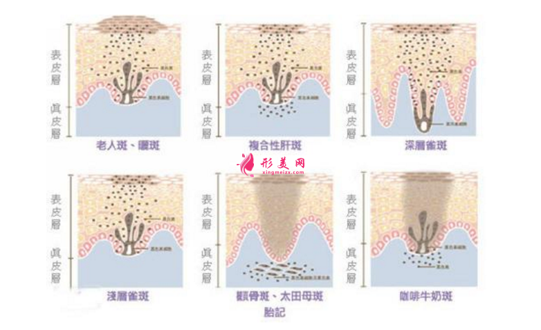 術(shù)前科普：激光祛斑多少錢一次？