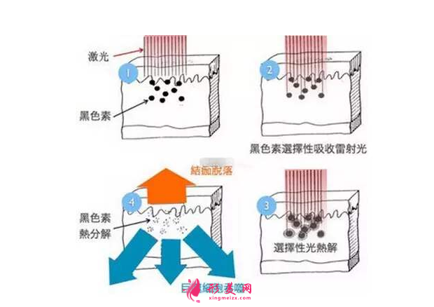 術(shù)前科普：激光祛斑多少錢一次？