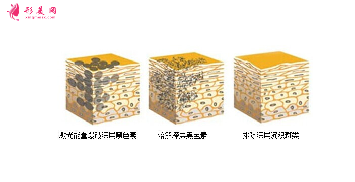 術(shù)前科普：激光祛斑多少錢一次？