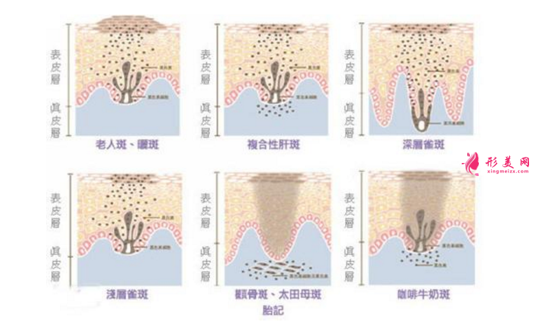 術(shù)前科普：激光祛斑多少錢一次？