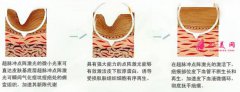 專家科普：怎么去除痘疤？價格是多少？