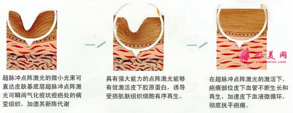 專家科普：怎么去除痘疤？價格是多少？