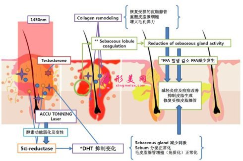 專家科普：怎么去除痘疤？價格是多少？