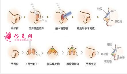 鼻翼整形的價格是多少？術(shù)后注意事項~