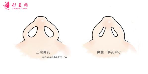 鼻翼整形的價格是多少？術(shù)后注意事項~