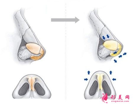 鼻翼整形的價格是多少？術(shù)后注意事項~