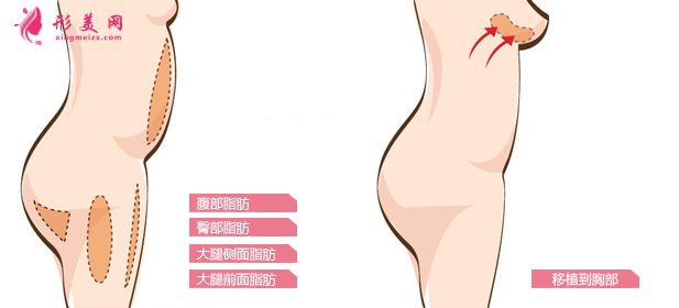 自體脂肪隆胸好嗎？術(shù)前準(zhǔn)備工作要知道！