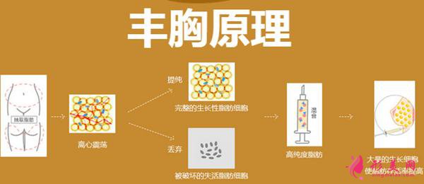 自體脂肪隆胸好嗎？術(shù)前準(zhǔn)備工作要知道！