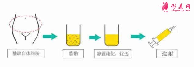 自體脂肪隆胸好嗎？術(shù)前準(zhǔn)備工作要知道！