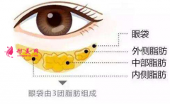 做手術(shù)切除眼袋多久恢復(fù)好？
