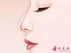 假體隆鼻多久鼻子不發(fā)紅？