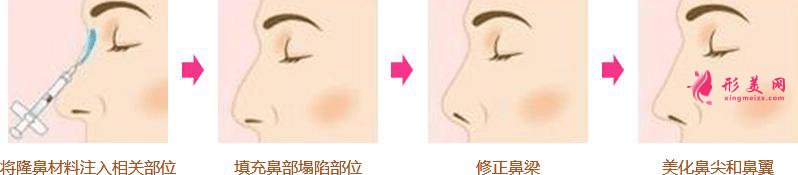 無痛隆鼻術是什么