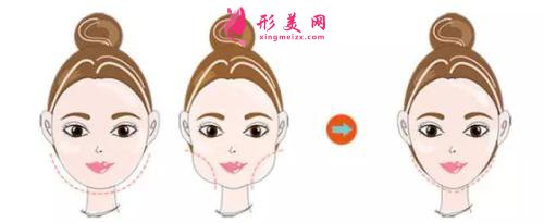 打瘦臉針效果怎么樣