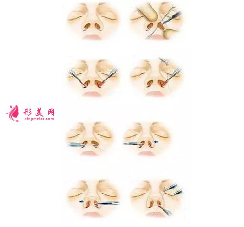 鼻翼整容術(shù)能收縮鼻翼嗎