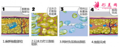 上臂吸脂切口在哪里？穿多久塑身衣？