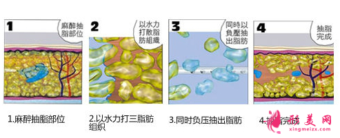 上臂吸脂一般什么價位