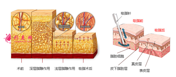 上臂吸脂一般什么價位