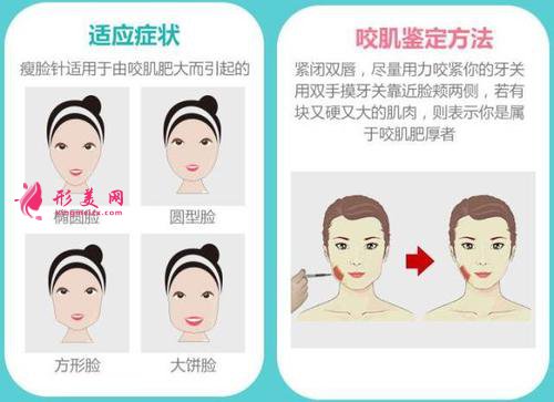 瘦臉針有效果嗎