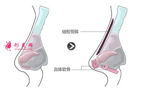 硅膠墊鼻梁維多少年