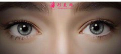 想要大眼睛！真的是愛了！美杜莎綜合美眼效果好嗎？
