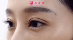鄭州整形醫(yī)院一般做雙眼皮手術(shù)多少錢？