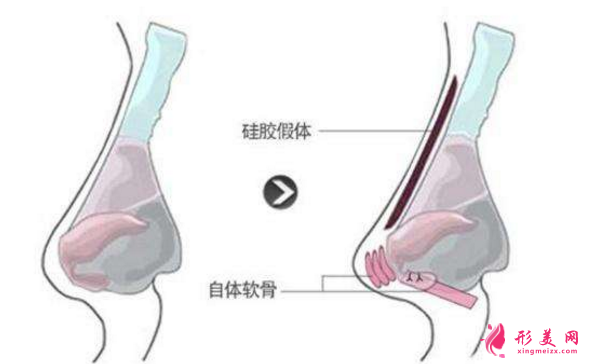 【術(shù)前科普】硅膠墊鼻梁多久要取出來？