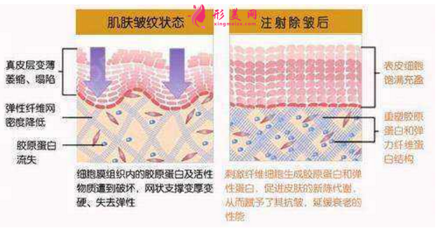 注射除皺效果怎么樣？附術(shù)前術(shù)后注意事項(xiàng)！