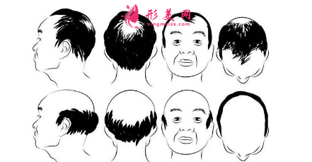頭發(fā)種植效果可靠嗎？術前注意事項大全！