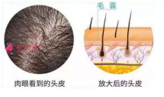 頭發(fā)種植效果可靠嗎？術(shù)前注意事項大全！