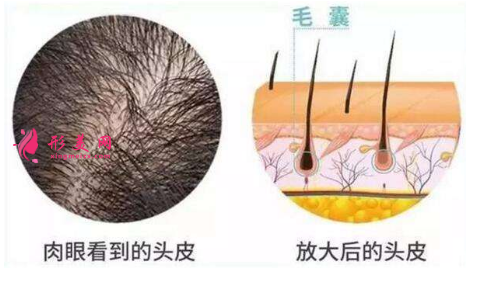 頭發(fā)種植效果可靠嗎？術前注意事項大全！