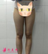 鄭大二附院整形科劉月麗抽脂怎么樣？大腿抽脂案例你i了嗎？