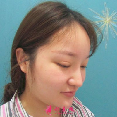 深圳顏美醫(yī)療美容門診部吸脂案例