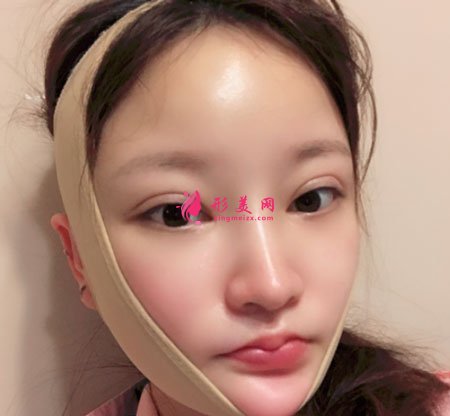 深圳顏美醫(yī)療美容門診部吸脂案例