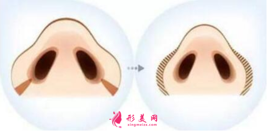 做鼻翼縮小痛不痛
