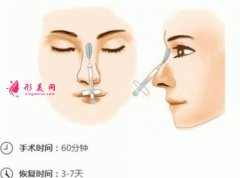 做自體脂肪隆鼻可能會變寬嗎?