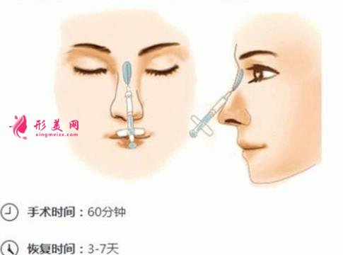 做自體脂肪隆鼻可能會變寬嗎?危害什么