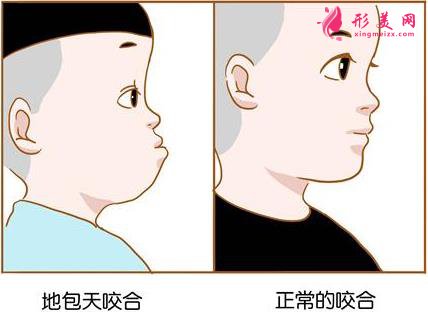 兜齒矯正的最佳年齡是多少歲?別讓兜齒影響孩子的一生!