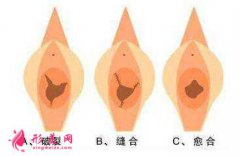 處女膜修復(fù)是怎么做的？手術(shù)大概流程
