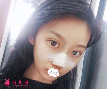 整形初體驗(yàn):假體隆鼻后整理的隆鼻經(jīng)驗(yàn)分享給大家【附圖】