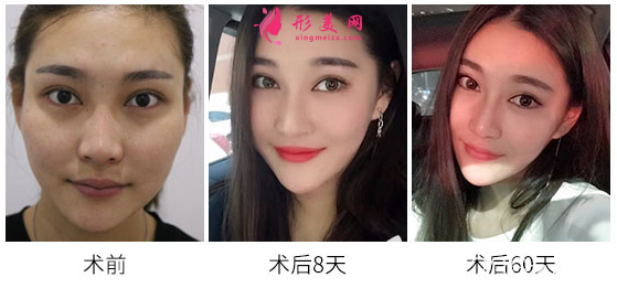 佛山華美學(xué)院梁宗建院長自體脂肪塑料面部填充的案例研究