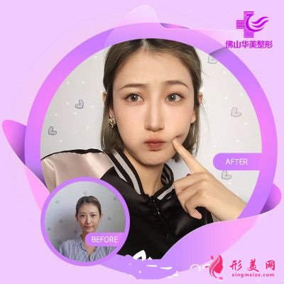 佛山華美醫(yī)用整形美容醫(yī)院透明質(zhì)酸注射液