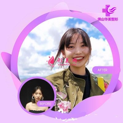 佛山華美整形美容醫(yī)院全面部自體脂肪填充病例分析