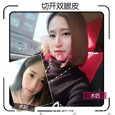 佛山華美梁宗堅(jiān)雙眼皮切開案