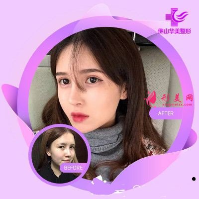 佛山華美整形美容醫(yī)院隆鼻術(shù)病例比較